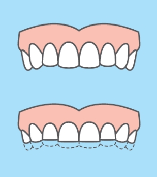 Опасность бруксизма зубов