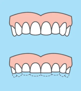 Опасность бруксизма зубов