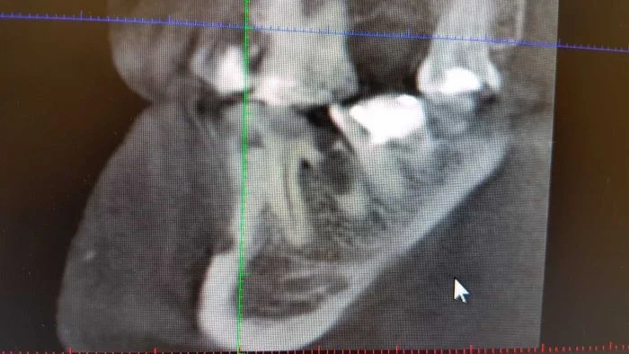 Последствия если не лечить кариес