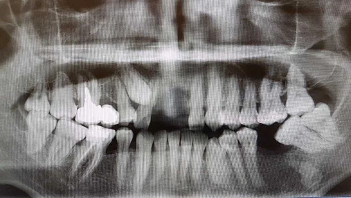 Непрорезавшийся клык  и новообразование - остеома