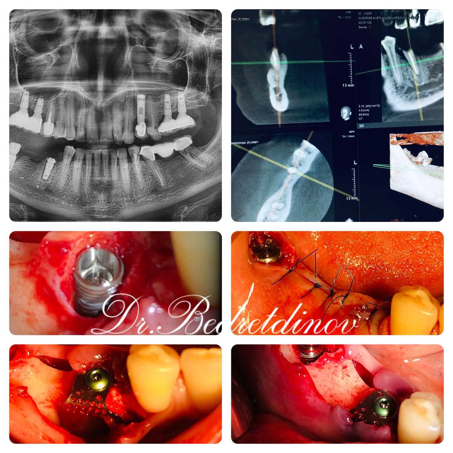 Вживление импланта