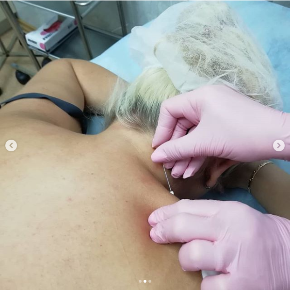 Процедура акупунктурного тредлифтинга