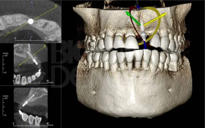 Компьютерная томография (КТ) челюстей