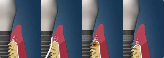 Периимплантит