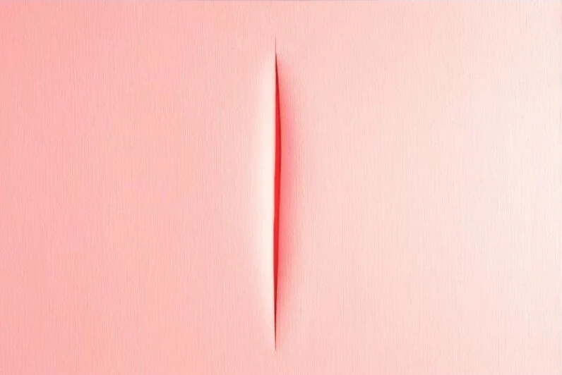 Гименопластика – восстановление девственной плевы