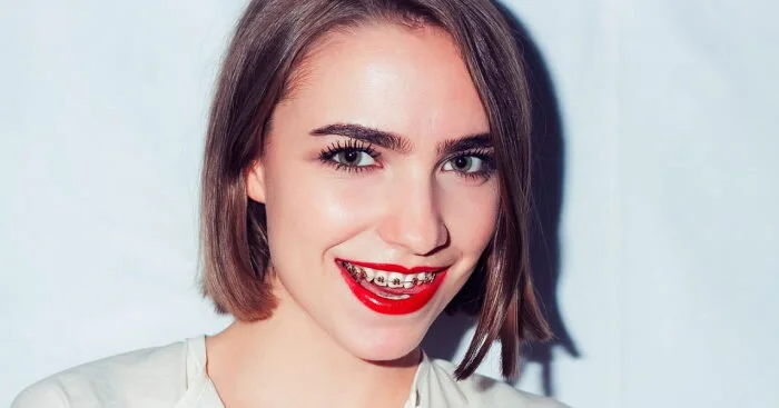 Вестибулярные брекеты