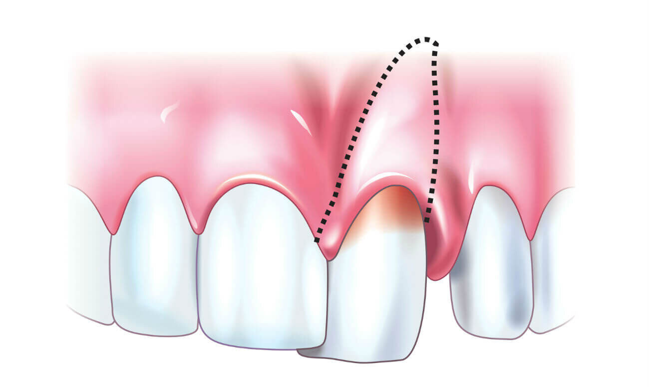 Закаленный зуб. Вколоченный вывих зуба рентген. Неполный вывих зуба рентген. Интрузия фронтальных зубов.
