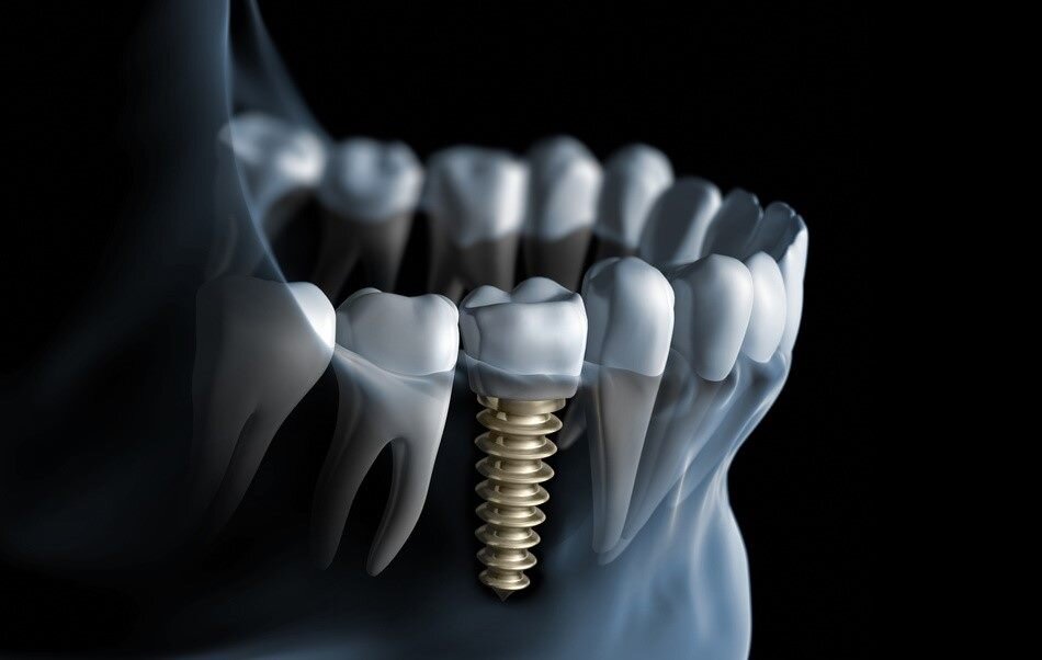 Имплантация зубов - методы и отзывы пациентов о зубных имплантах. Часть 1