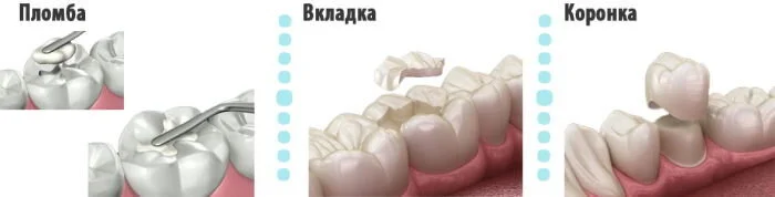 Вкладка коронка на зуб фото Вкладка коронка на зуб фото