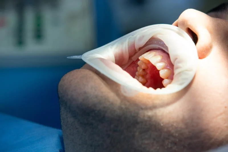 Гранулемы зуба