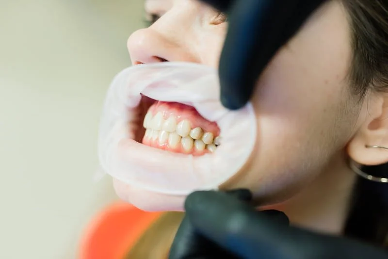 Запечатывание&nbsp;фиссур&nbsp;&nbsp;(см. герметизация фиссур)