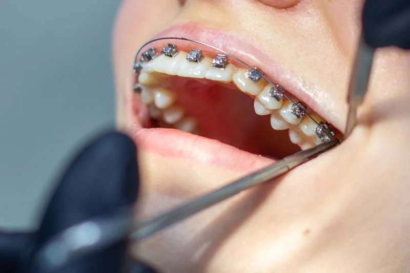 Дизокклюзия