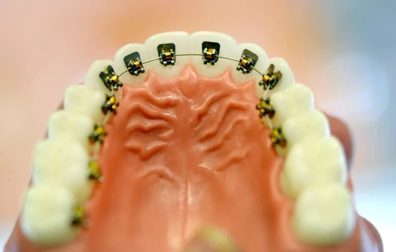 Иммобилизация зубов