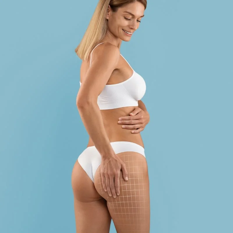 Как избавиться от растяжек?