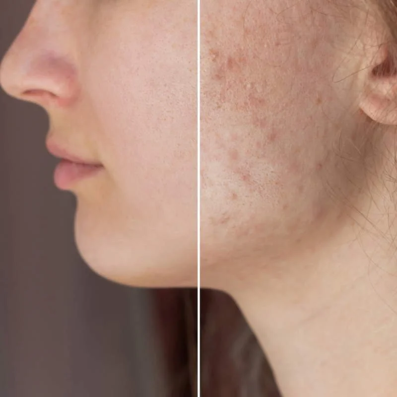 Лечение постакне лазером