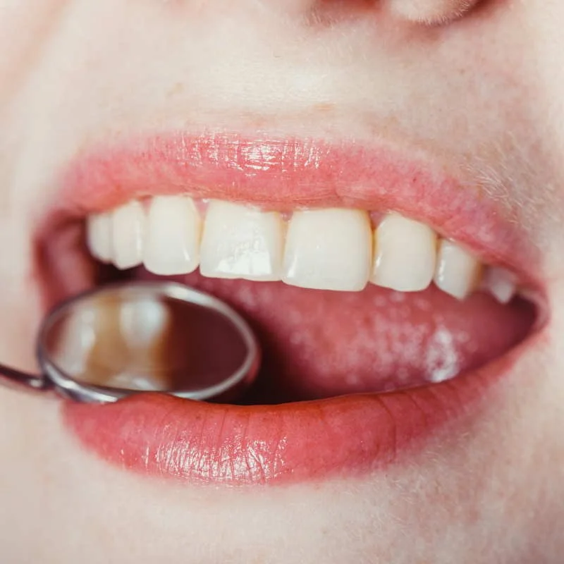 Белые пятна на зубах: стоит ли волноваться?