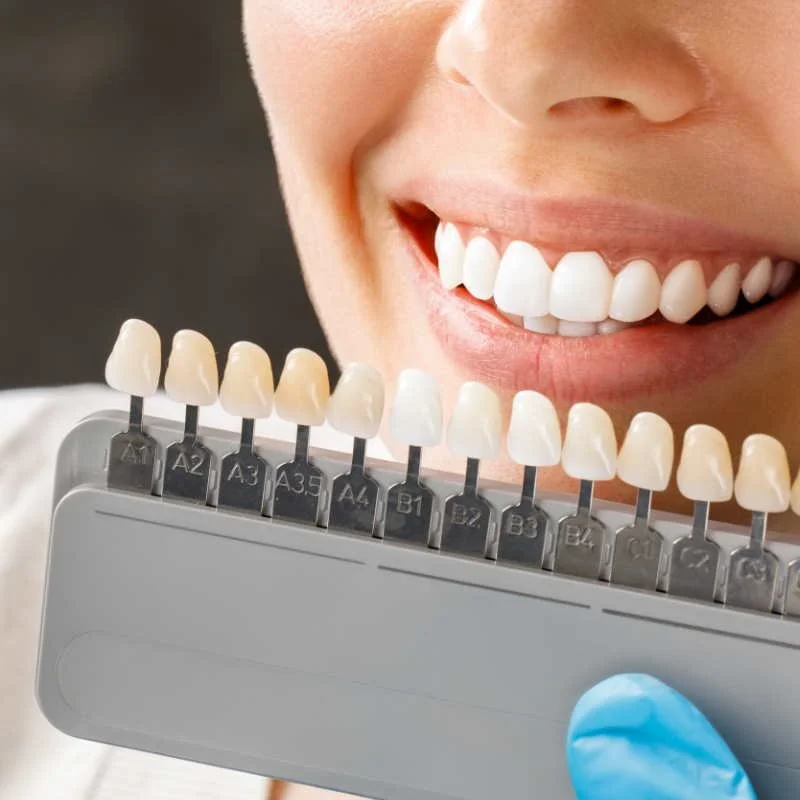 Виниры или люминиры?