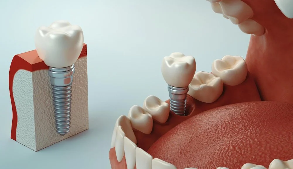 Имплантация при недостатке (атрофии) кости