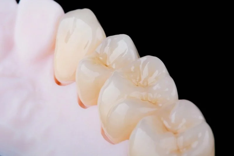 Коронка на свой зуб (на живой или депульпированный)