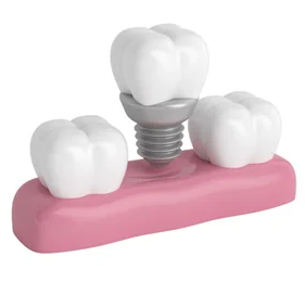 Имплантация зубов