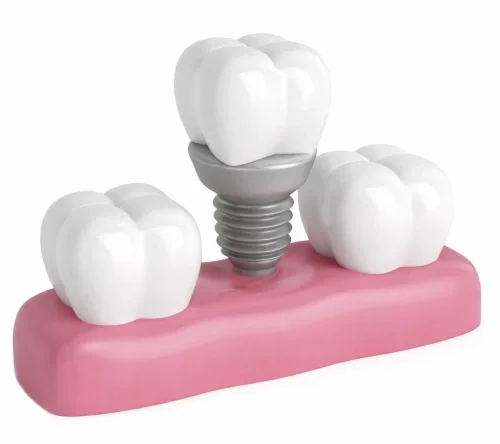 Имплантация зубов