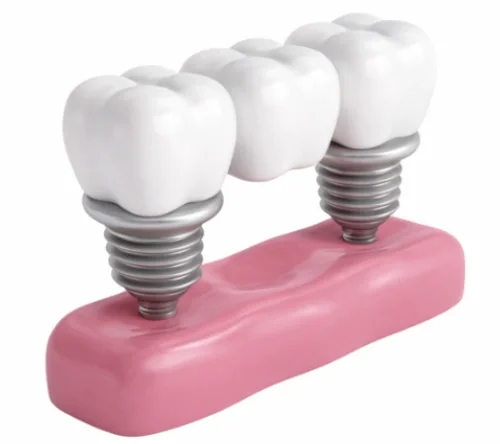 Мостовидные протезы