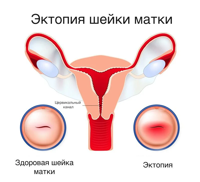 Кровотечение шейки матки: причины и возможные решения