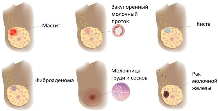 Причины возникновения мастита