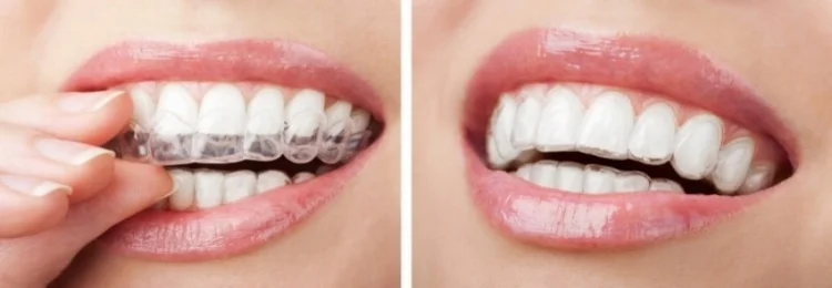 invisalign.jpg