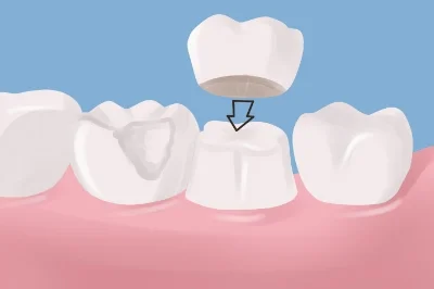 Dental-Crowns.jpg