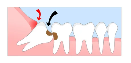 wisdom teeth 1.jpg