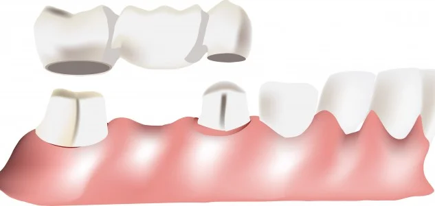 Dental-Bridge-633x300.jpg
