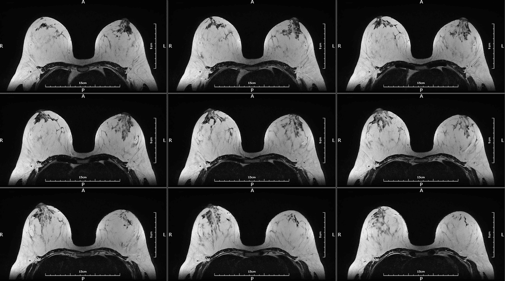 Dedicated Breast Cancer screening MRI — Time Medical