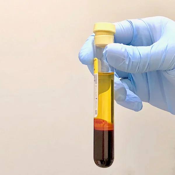 This is my blood after it’s been in the centrifuge. The top, yellowish portion is the platelet-rich plasma used in this treatment.