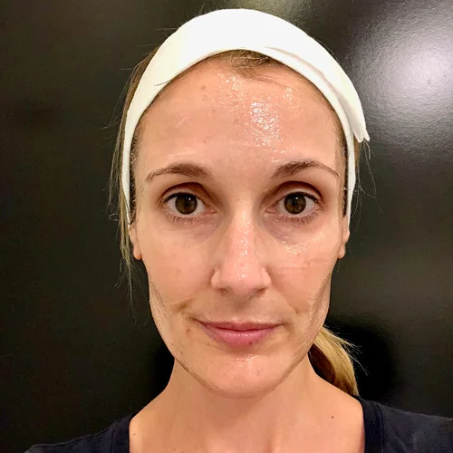 Numbing gel is applied approximately 30 minutes before the treatment. It covers your entire face.