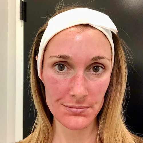 It pretty much feels like a sunburn - sensitive and tight. The plasma is washed off about 6 hours later and then my face only feels sensitive. I baby it with a TON of hyaluronic acid.