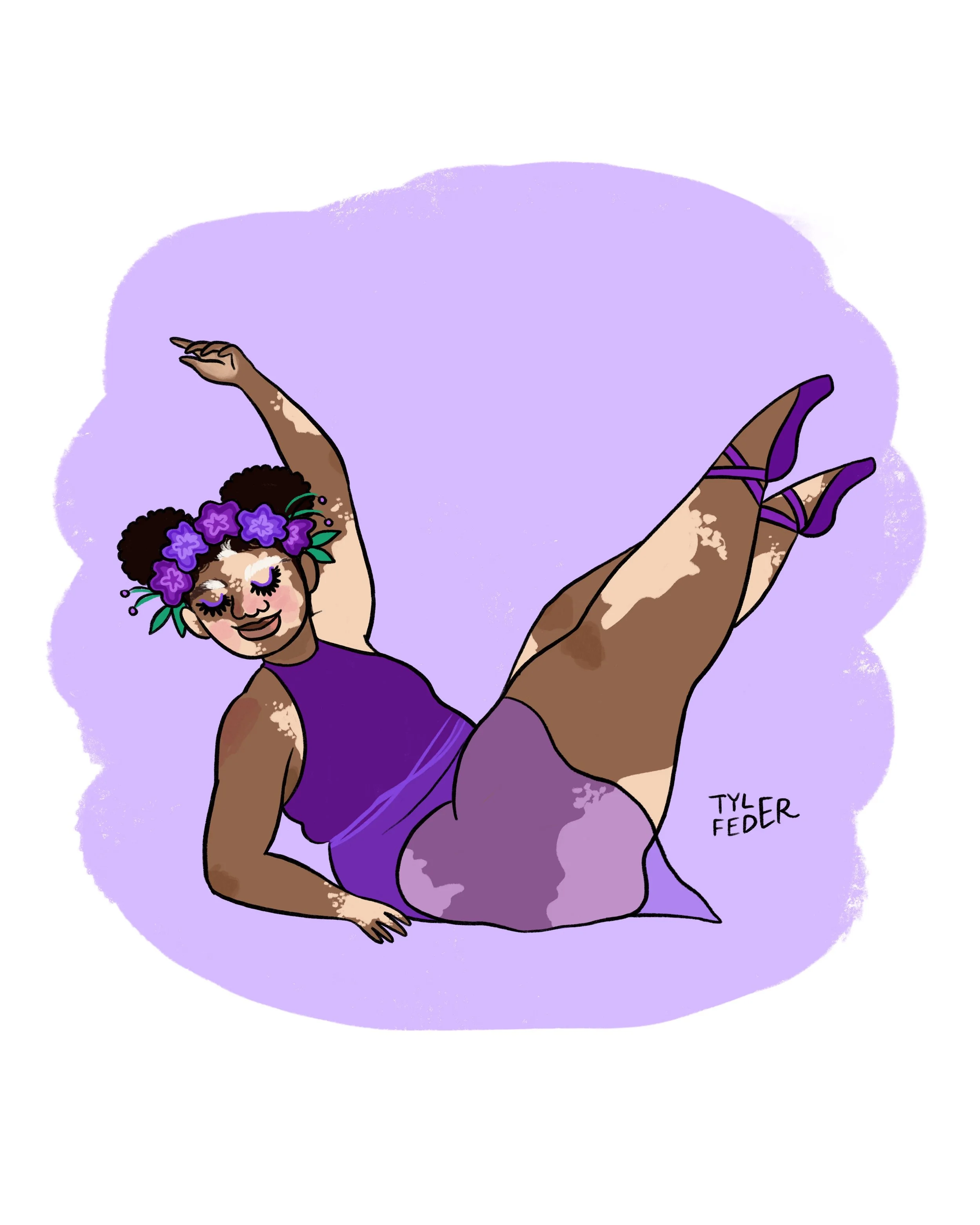 V is for vitiligo!