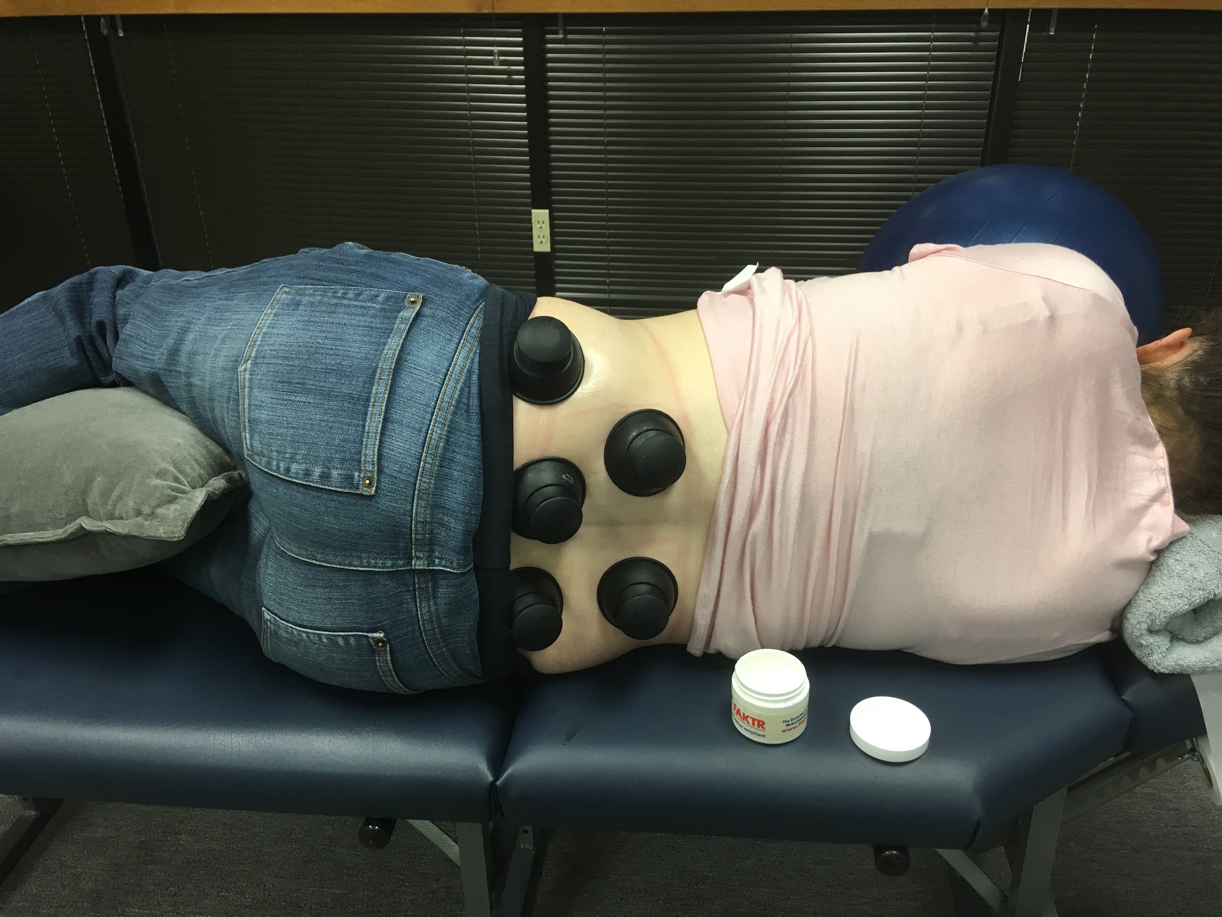 Cupping for lower back pain. 