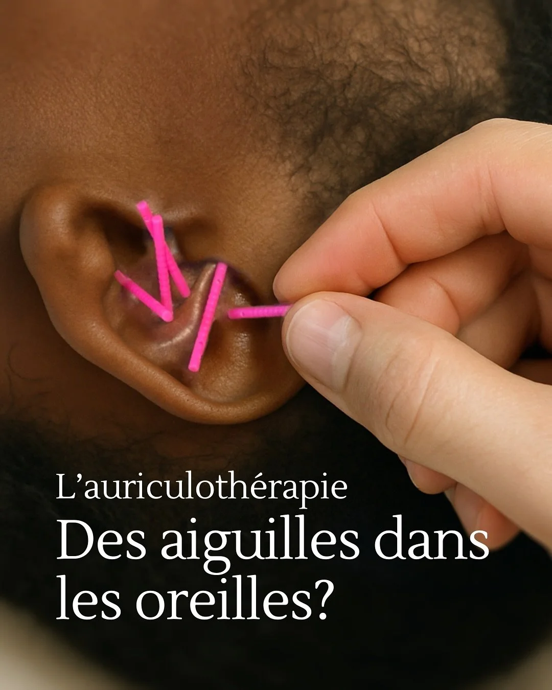 Pourquoi stimuler l&rsquo;oreille plut&ocirc;t qu&rsquo;un autre endroit du corps?

L&rsquo;oreille est une zone r&eacute;flexe directement connect&eacute;e au cerveau. Elle contient des centaines de terminaisons nerveuses, dont plusieurs reli&eacute