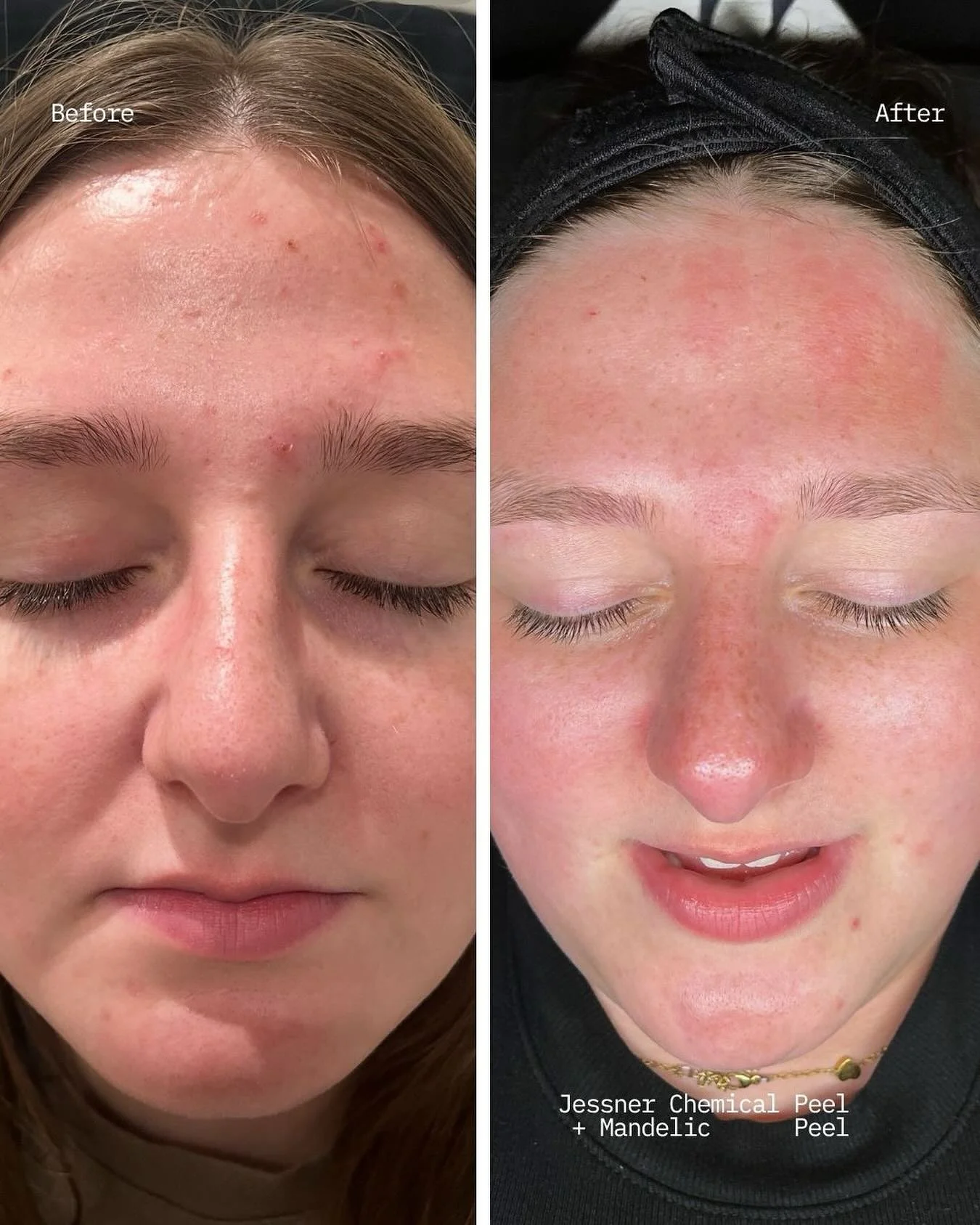 Jessner Peel + Mandelic Peel = THE Ultimate Holiday Glow Up

Consistency is key🔐

DM &ldquo;Glow&rdquo; to get your skin holiday ready by Christmas🎄✨

#slay #skinhealth #wichitaesthetician #wichitaks #holidayskin #skinprep #skingoals