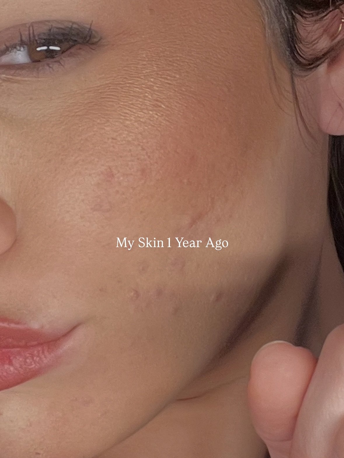 Dealing with annoying skin stuff?

So was I. About a year ago.

Guess what? I changed.

And I haven&rsquo;t looked back since.👇

Lifestyle and diet is the last thing we want to change. Give up dairy? Yeah right. No more drinking? Get reallll. 

Is t