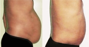LL-belly-male.png