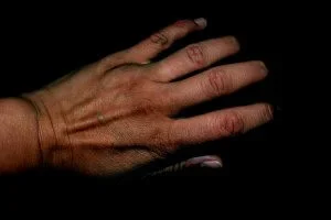 arthritis.jpg