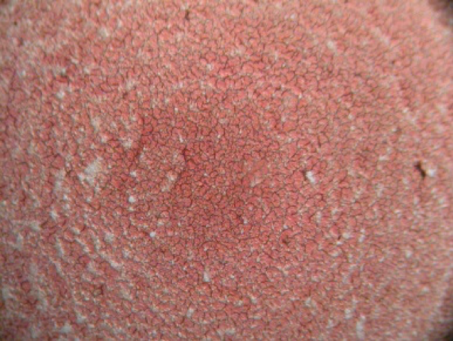 Peripheral smear of her blood at Initial Workup