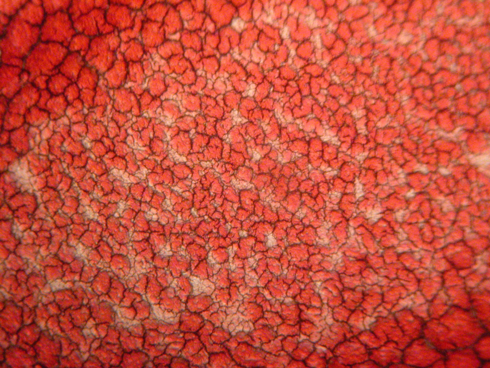 Here peripheral smear of her blood at that time.