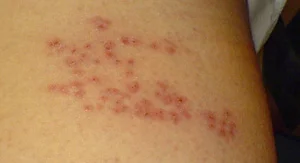 shingles.jpg