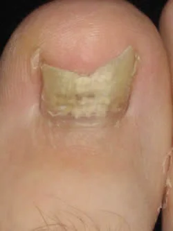 toefungus.jpg