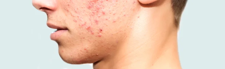 Acne 2.jpg