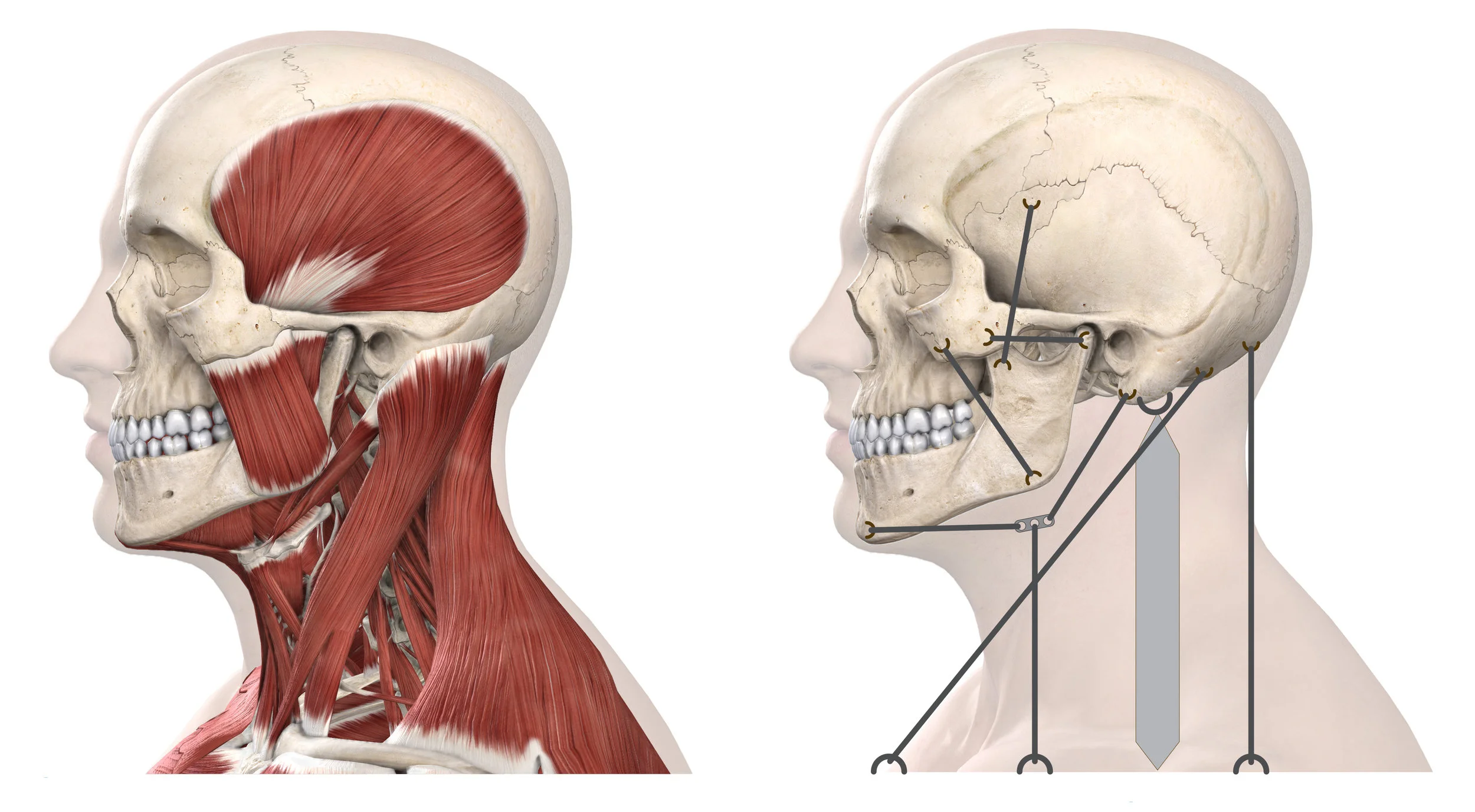 TMJD Skull Muscle Strings.jpg