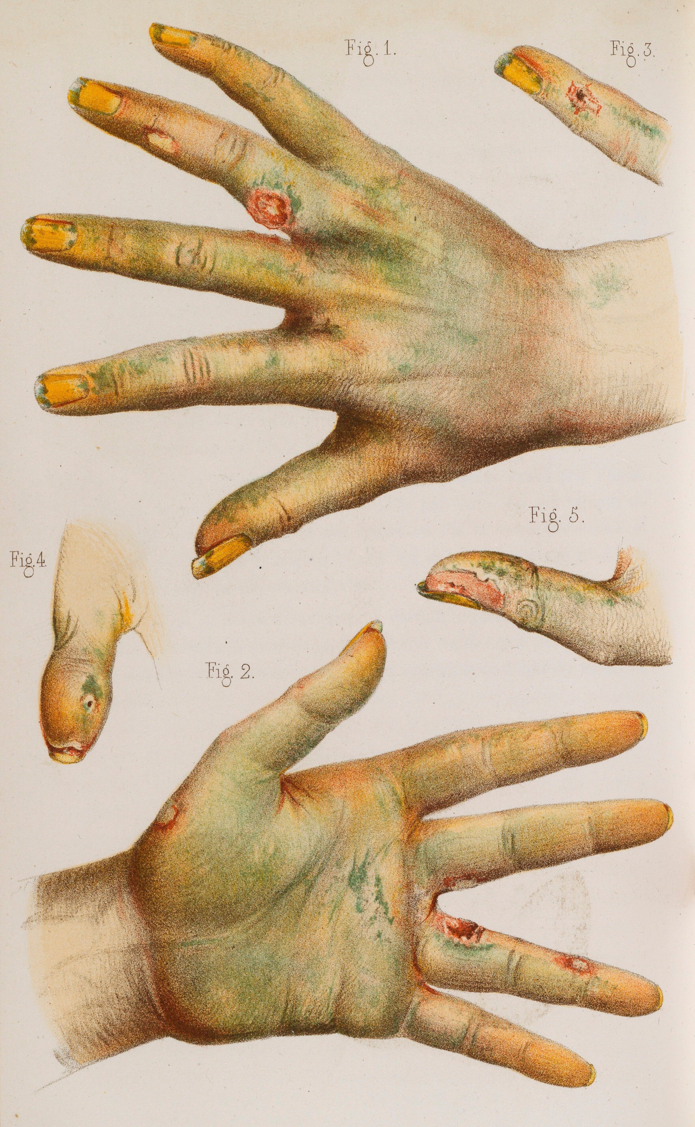 This illustration shows the kinds of wounds that artificial flower workers and other working with arsenical dyes experienced as a result of their dangerous work. Courtesy of the Wellcome Collection.